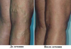 Варикозное  расширение  вен  на  ногах и его лечение